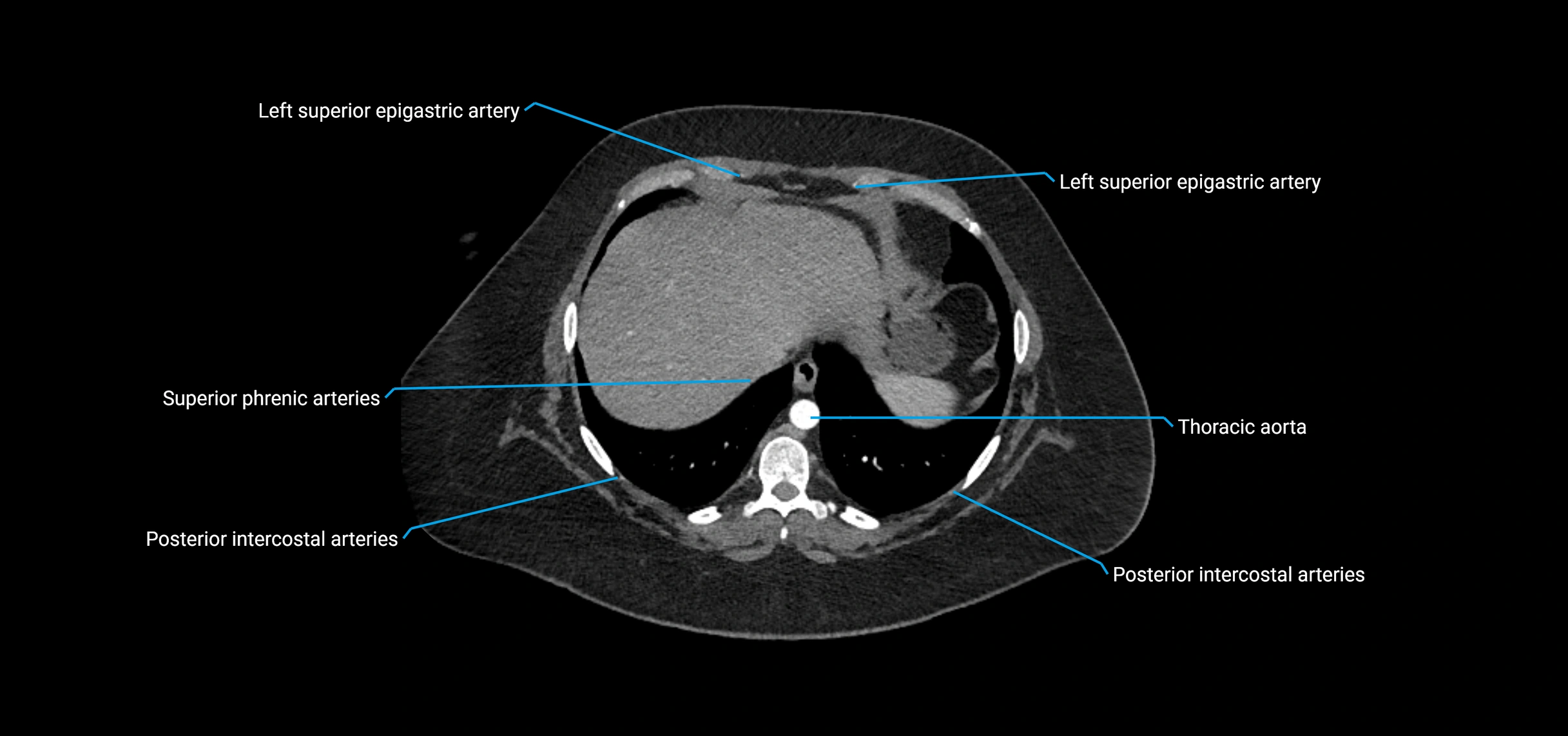 CTA abdomen axial cross sectional anatomy labelled image_19 (2).webp